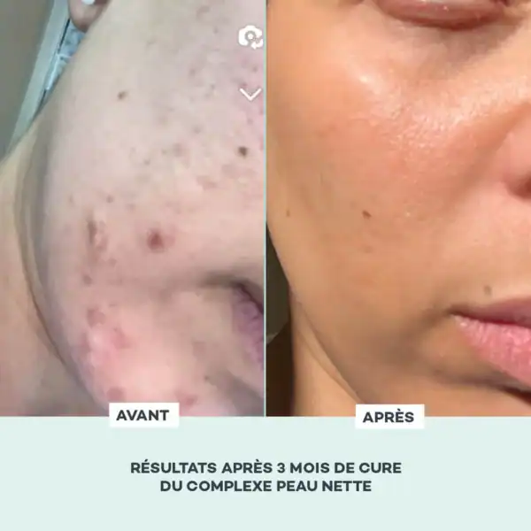Complexe Peau Nette – Image 4